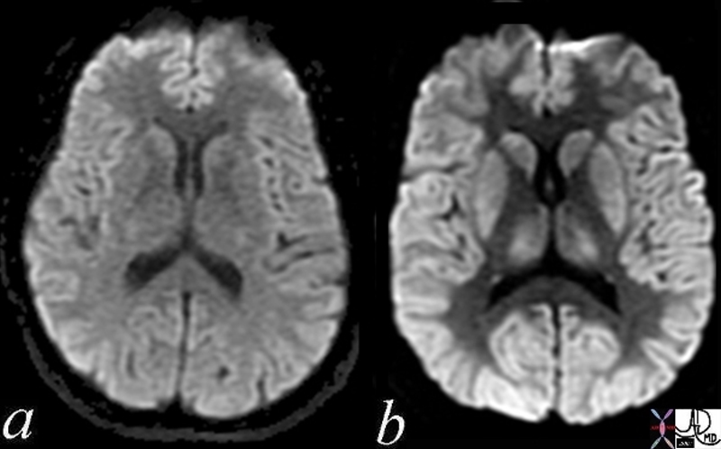 Basal Ganglia | Brain